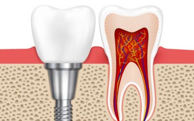 Why Do Dental Implants Cost So Much?