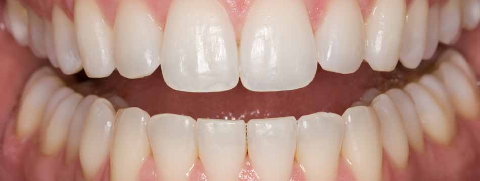 tooth whitening after