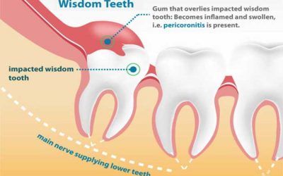 Do My Wisdom Teeth Have To Come Out?