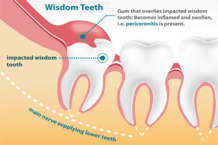 Does Wisdom Teeth Come With Age