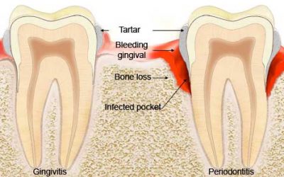 Gingivitis – Everything You Need To Know