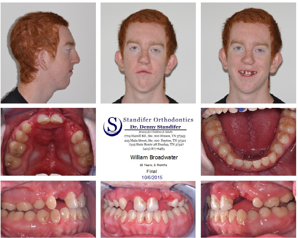 case study 101 cleft palate