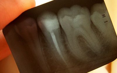 See The Full Picture On Dental X-Rays