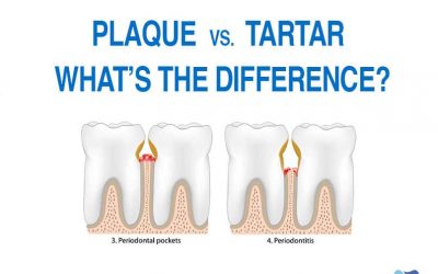 Plaque vs. Tartar: What’s The Difference?