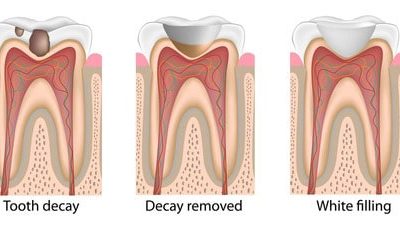 What Are the Options When Needing A Filling? 5 Types Of Dental Fillings