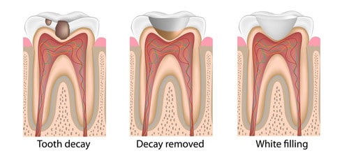 Types of on sale tooth fillings