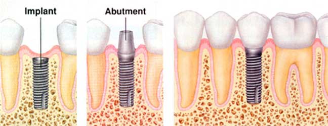 dental implant for broken tooth