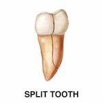 split tooth