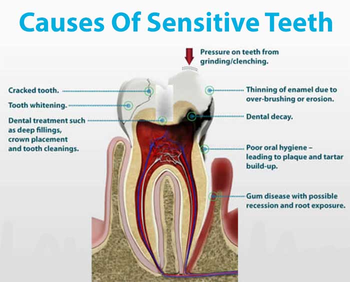 All The Nerves In My Teeth Hurt TeethWalls