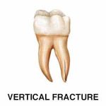 vertical root fracture