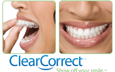 Invisalign Patents Are Running Out What Does This Mean For People Wanting Invisalign “Braces”?