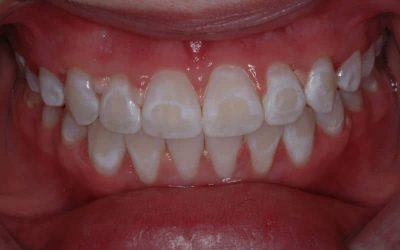 Teeth Have White Spots? What Can Be Done?