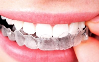 Maintaining Your Smile After Braces