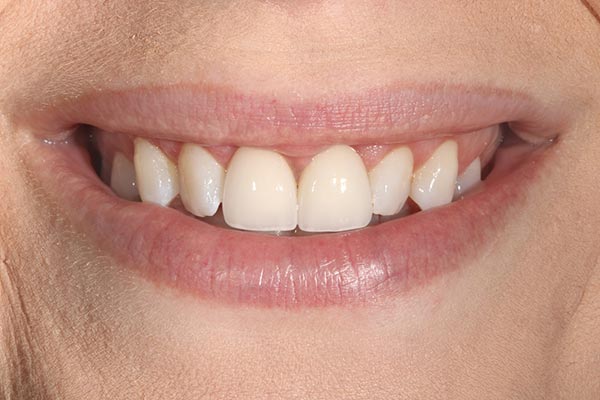 patient after crown lengthening