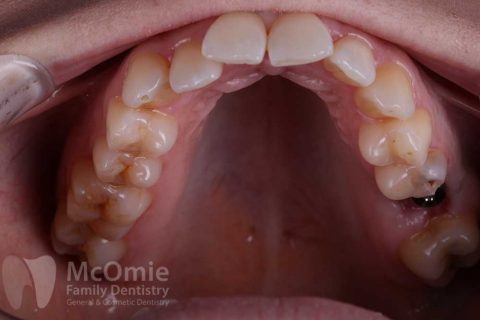 Clear Correct Aligners Patient Before And Afters - McOmie Dentistry ...