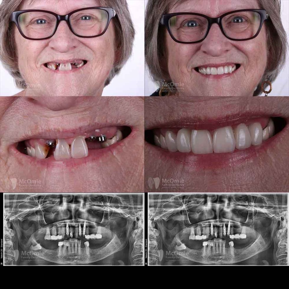 Dental Implants Patient Before and Afters - McOmie Dentistry Chattanooga
