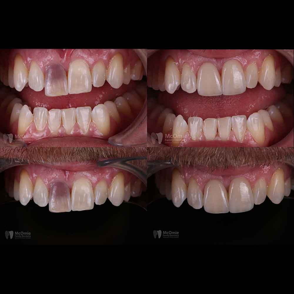 Does a Dental Veneer Treatment Damage Teeth? - Gables Exceptional
