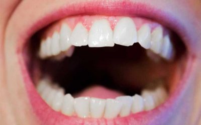 How to Fix a Chipped, Cracked or Broken Tooth