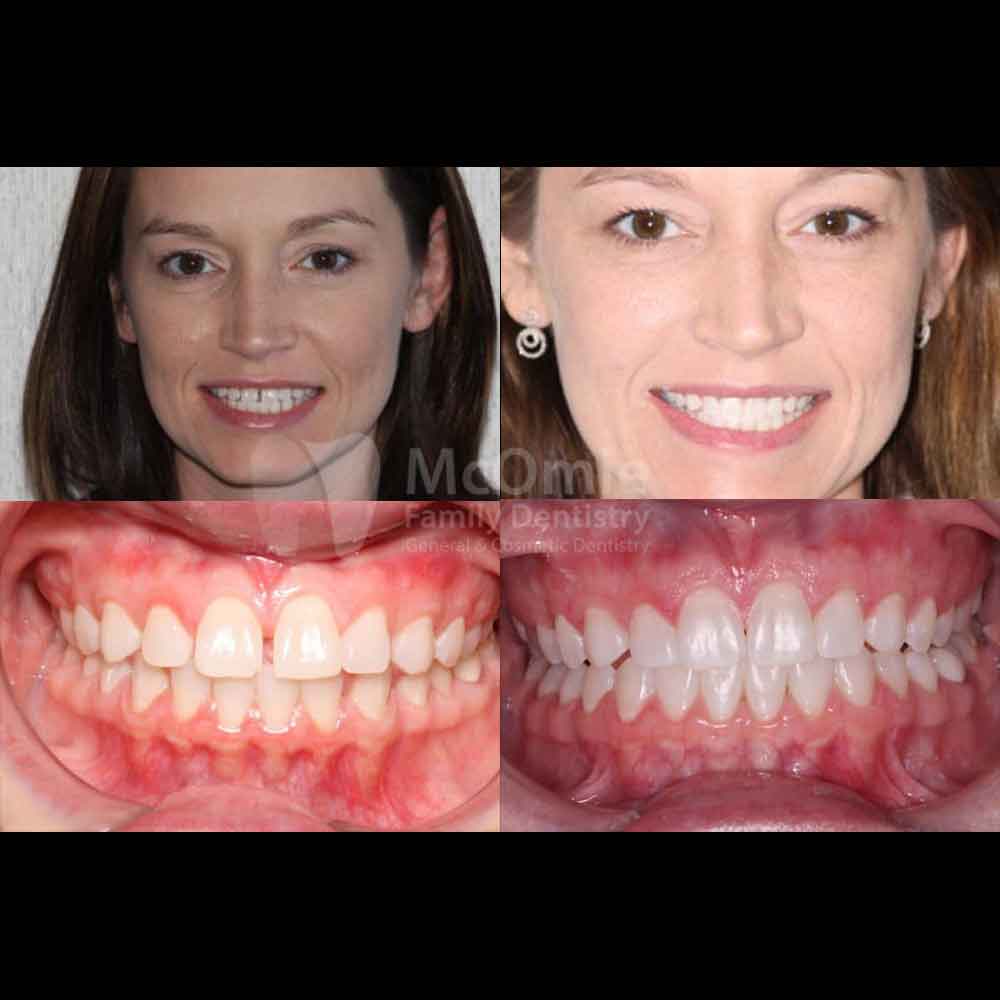 Clear Correct Aligners Patient Before and Afters - McOmie Family
