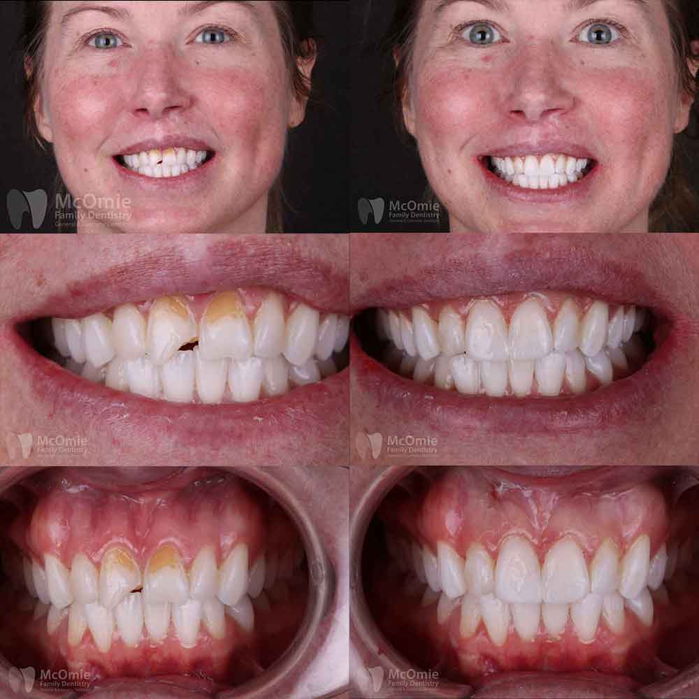 Dental Bonding Before After M0 