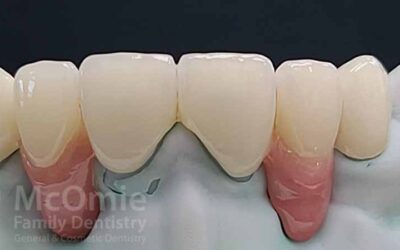 The Comprehensive Guide to Dental Bridges