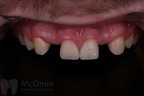 Dental Crowns and Bridges Before and After - McOmie Dentistry Chattanooga