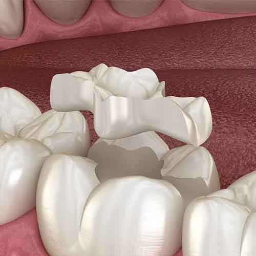 dental inlays procedure