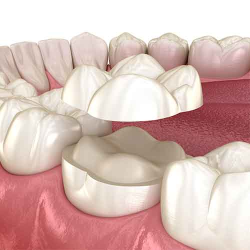 dental onlays procedure