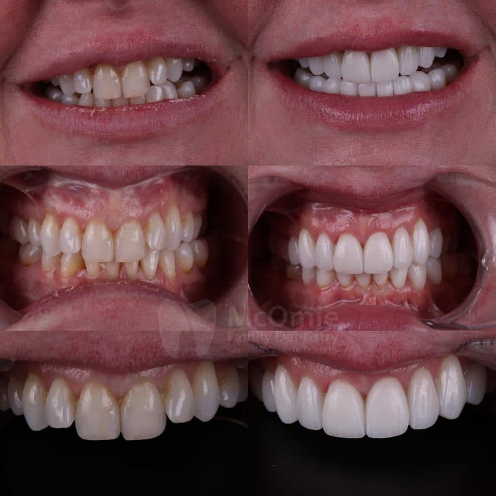 crooked teeth before and after veneers