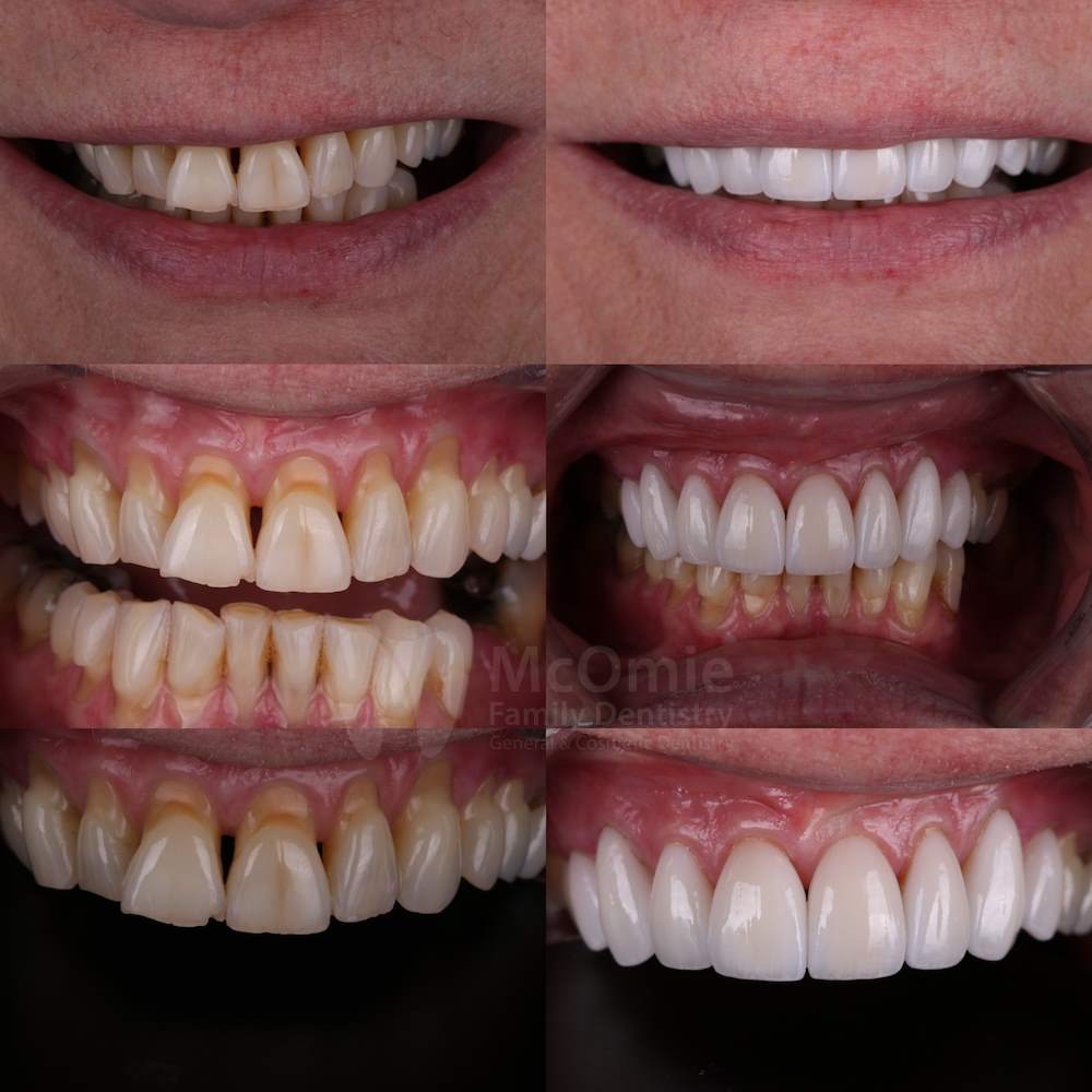 Clear Correct Aligners Patient Before and Afters - McOmie Family