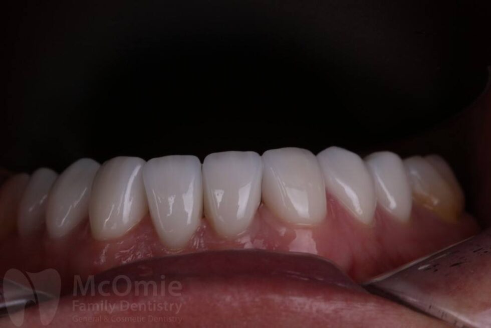 Full Mouth Reconstruction Patient Before And Afters Mcomie Dentistry Chattanooga