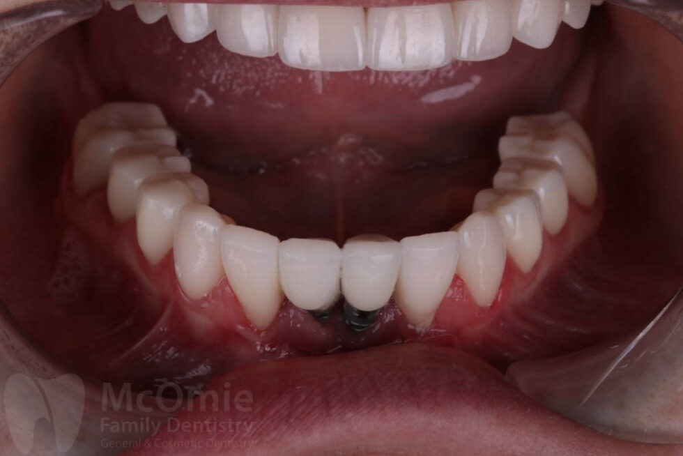 Full Mouth Reconstruction Patient Before And Afters - McOmie Family ...