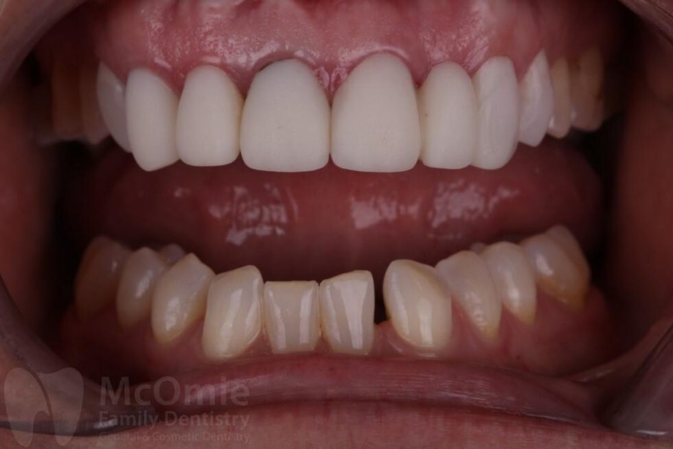 Full Mouth Reconstruction Patient Before And Afters - McOmie Dentistry ...