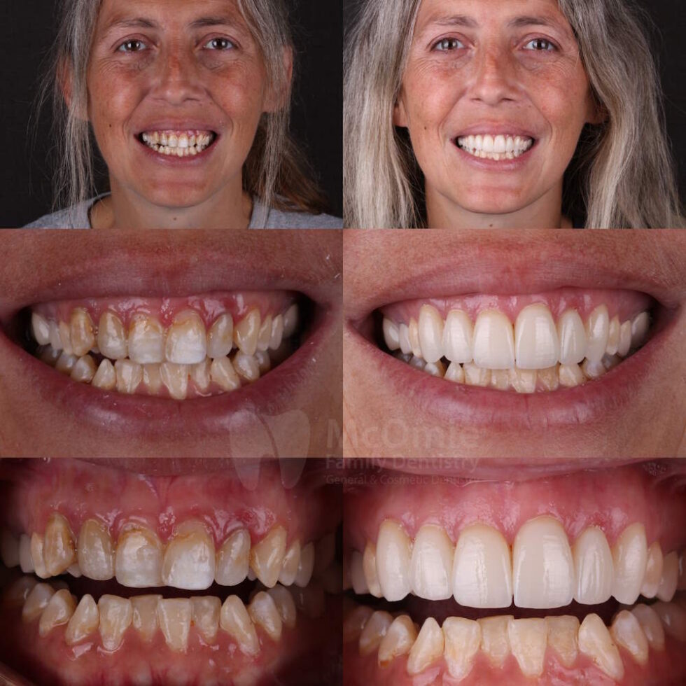 Veneers Patient Before and Afters Family Dentistry