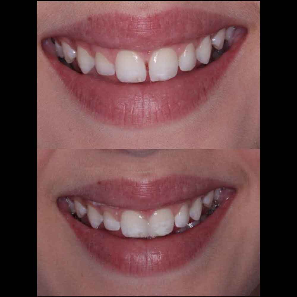 Resin Bonding Patient Before and Afters - McOmie Family Dentistry