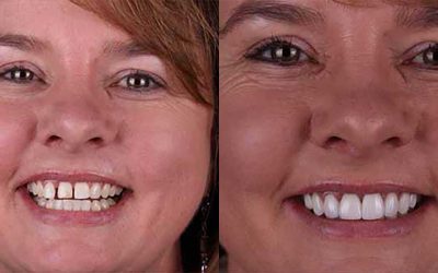 Common Smile Problems That Cosmetic Dentistry Can Fix