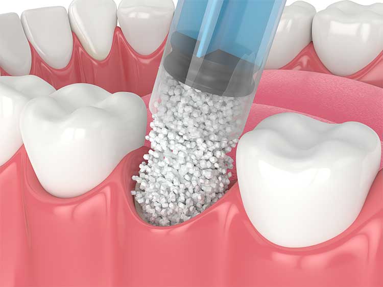 filling tooth socket with bone material