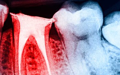 Difference Between a Root Canal and a Tooth Extraction