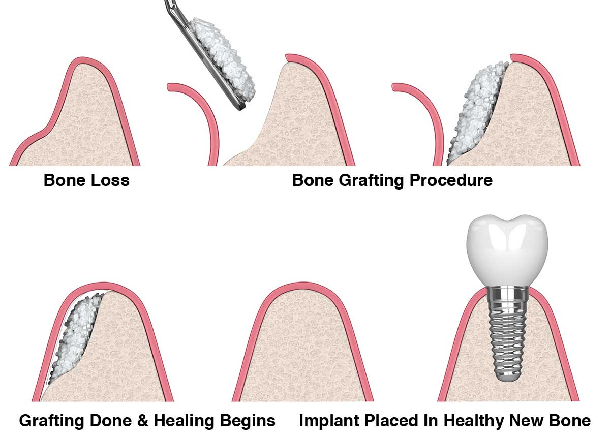 tooth bone graft procedure illustration