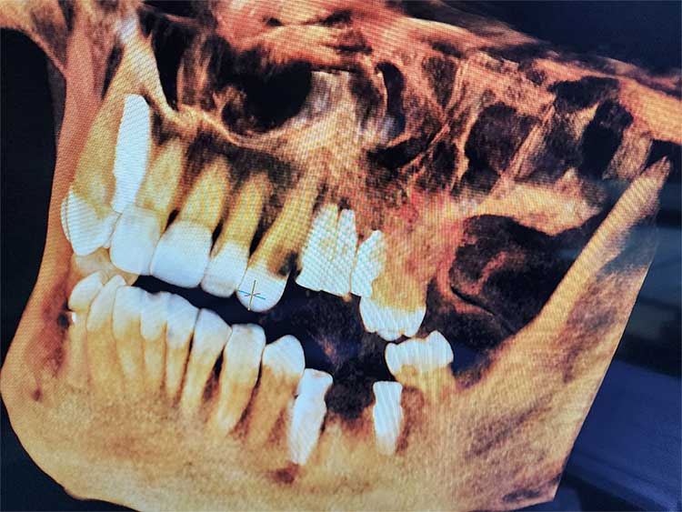 After 3D CBCT Scan Showing New Implant Teeth
