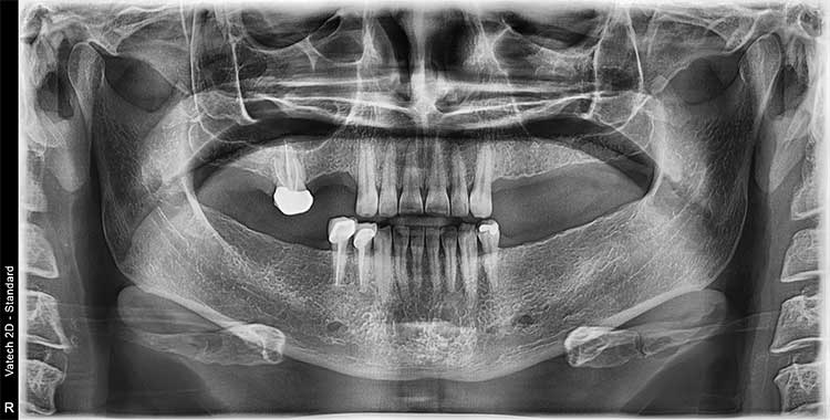 Pre Op 2D Panorex Showing Patients Missing Teeth
