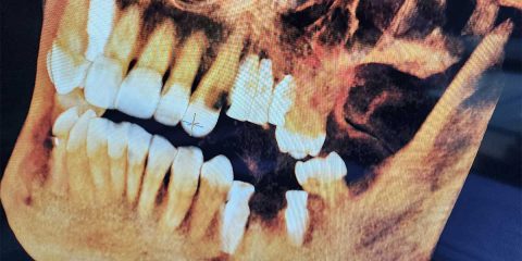 3D CBCT Imaging and its Impact on Dental Implant Procedures - McOmie ...