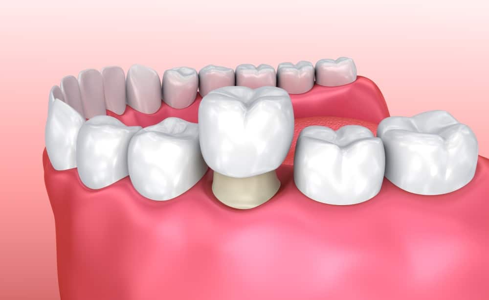 Essential Guide to Dental Crowns