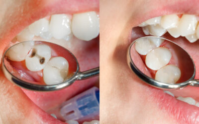 Why Composite Fillings Are the Superior Alternative to Amalgam