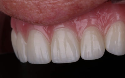 Smile Confidently Again: The Benefits of Implant-Supported Dentures
