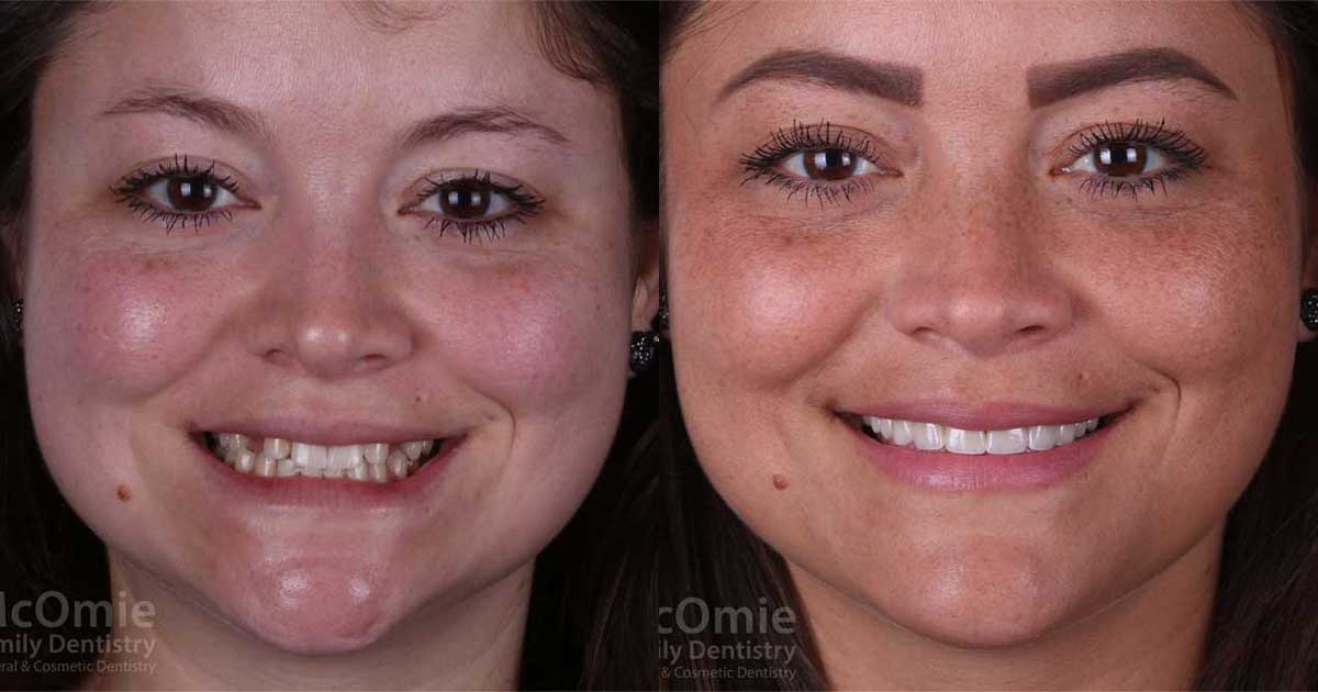 Single tooth dental implant procedure in Chattanooga to replace one missing tooth and preserve jawbone health