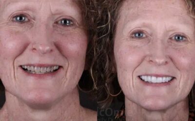 Tetracycline Stains: Veneers vs Whitening vs Crowns, What Actually Works