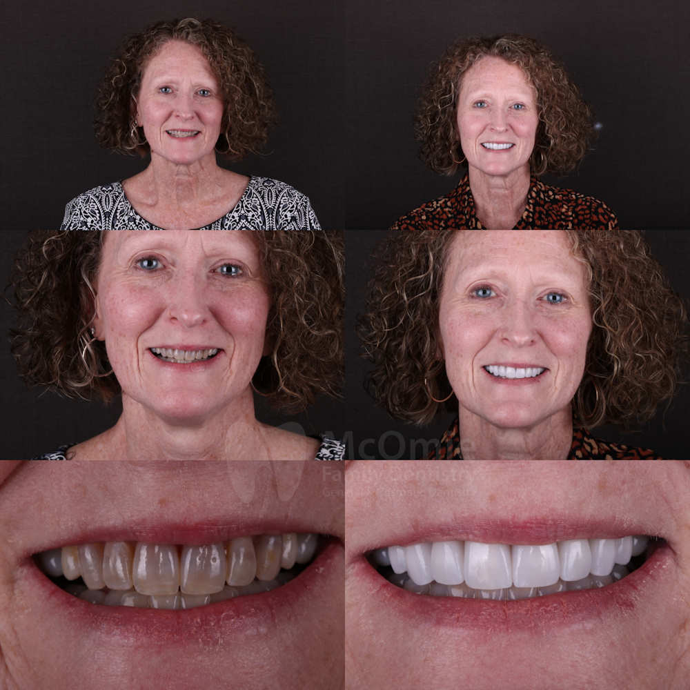 Before and after zirconia ceramic veneers for tetracycline stains in Chattanooga.