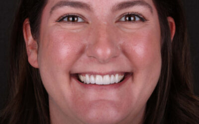 Will My Veneers Look Fake? How McOmie Dentistry Creates Natural Smiles In Chattanooga