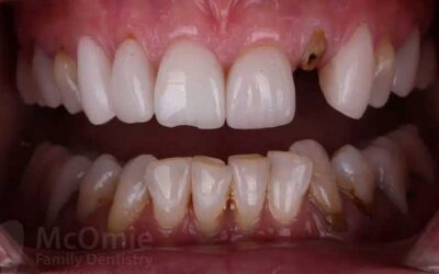 What to Do If Your Dental Crown Falls Off and What Not to Do